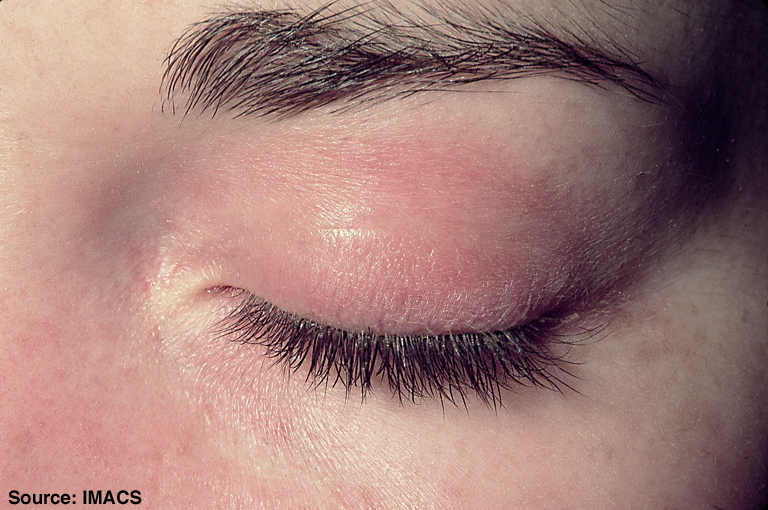 Published clinical photograph showing a purple eyelid rash with swelling