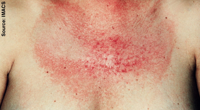 Published clinical photograph showing rash across the upper chest in a V-shaped distribution